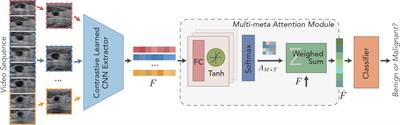 Contrastive learning–guided multi-meta attention network for breast ultrasound video diagnosis